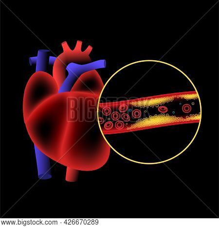 Cholesterol In Human Blood Vessels And Heart Logo. Fat Cells In Vein Arteries. High Ldl And Hdl Leve