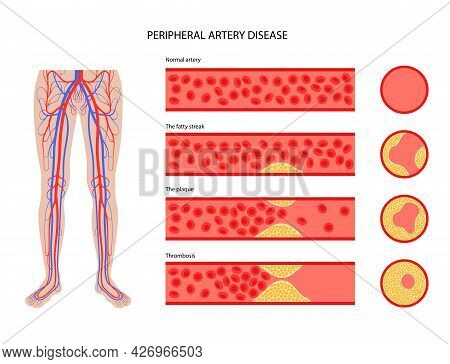 Peripheral Artery Disease. Ischemia In Leg. Cholesterol In Human Blood Vessel. Pad Concept. Fat Cell