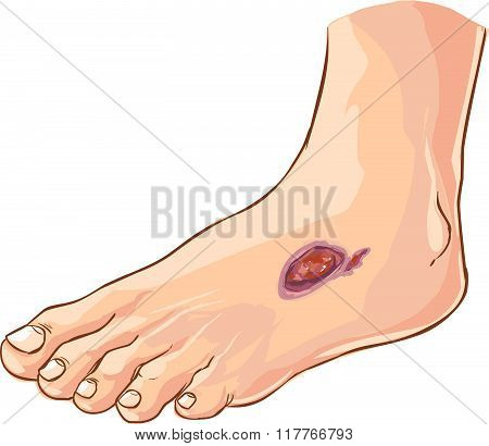 Vector Illustration Of A Medical Diabetic Foot