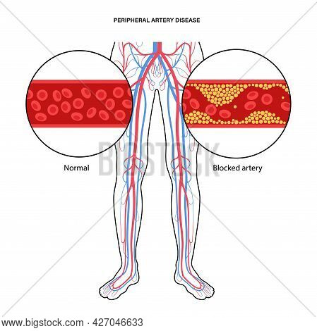 Peripheral Artery Disease. Ischemia In Leg. Cholesterol In Human Blood Vessel. Pad Concept. Fat Cell