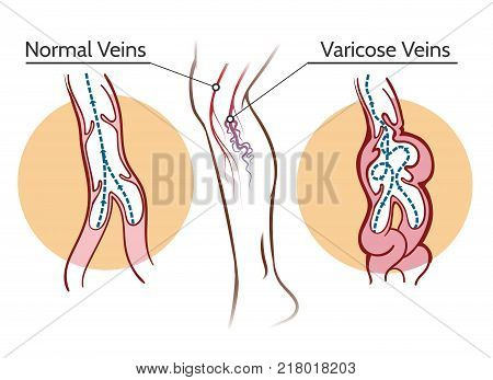 Varicose veins. Healthy leg vascular system and vessels thrombosis vector illustration