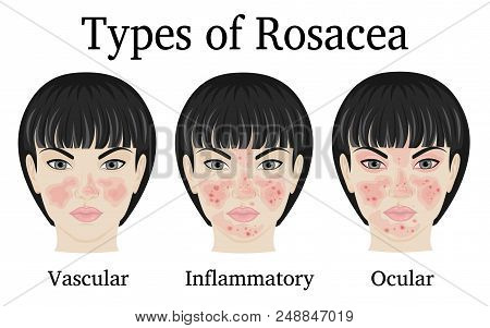 Three Types Of Rosacea - Vascular, Inflammatory And Ocular For Example Depicted On The Face Of A You