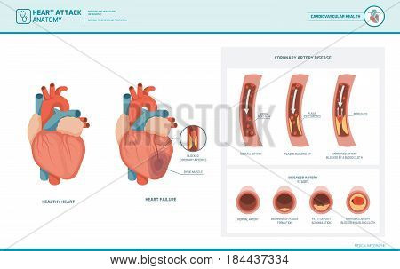 Heart attack and atherosclerosis medical illustration: healthy and damaged heart blood vessel section with fatty deposit accumulation