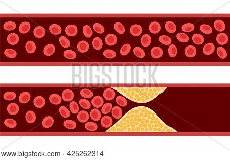 Arteriosclerosis, Infarct, Ischemia, Thrombosis Disease. Cholesterol In Human Blood Vessels. High Ld