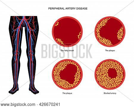 Peripheral Artery Disease. Ischemia In Leg. Cholesterol In Human Blood Vessel. Pad Concept. Fat Cell