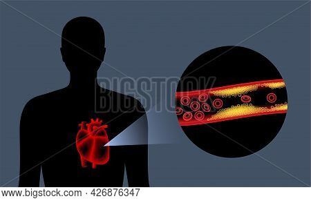 Cholesterol In Human Blood Vessels. Heart Logo In Man Silhouette. Fat Cells In Vein. High Ldl And Hd