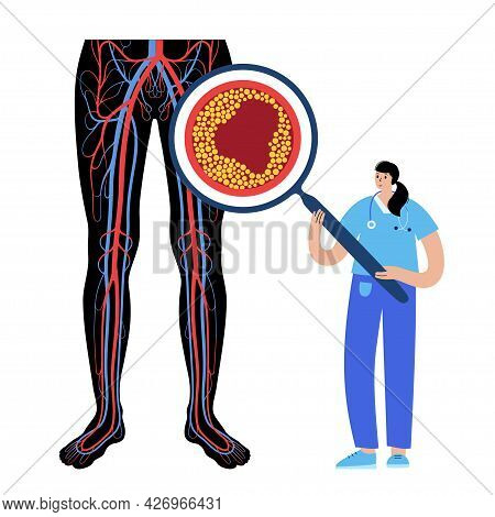 Peripheral Artery Disease. Ischemia In Leg. Cholesterol In Human Blood Vessel. Pad Concept. Fat Cell