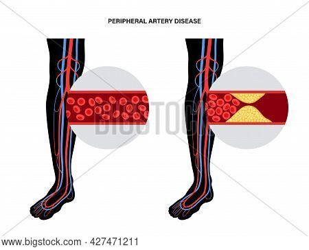 Peripheral Artery Disease. Ischemia In Legs And Hands. Cholesterol In Human Blood Vessel. Pad Concep