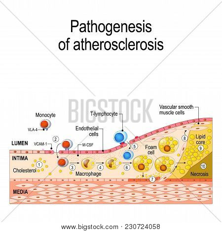 Pathogenesis Of Atherosclerosis. Cholesterol Plaque, And Thrombus Formation. Cells Structure (vascul