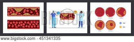 Cholesterol In Human Blood Vessels. Fat Cells In Vein And Artery. High Ldl And Hdl Level. Blocked Va