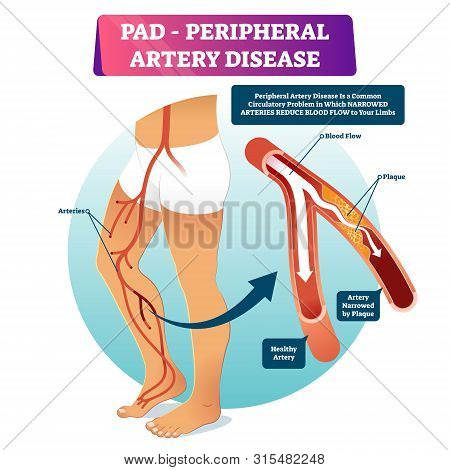 Peripheral Artery Disease Pad Vector Illustration. Labeled Medical Structure Scheme With Healthy Or 