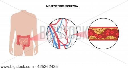 Mesenteric Ischemia, Cholesterol In Human Blood Vessels. Colitis In Intestine. Fat Cells In Vein Art