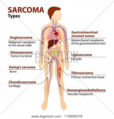 Types Sarcoma