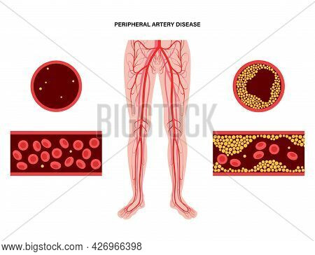 Peripheral Artery Disease. Ischemia In Leg. Cholesterol In Human Blood Vessel. Pad Concept. Fat Cell