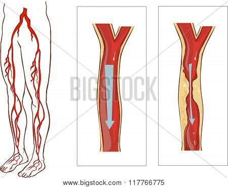 Vector Illustration Of Avascular System Legs. Atherosclerosis In Artery