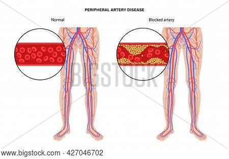 Peripheral Artery Disease. Ischemia In Leg. Cholesterol In Human Blood Vessel. Pad Concept. Fat Cell