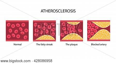 Arteriosclerosis, Infarct, Ischemia, Thrombosis Disease. Cholesterol In Human Blood Vessels. High Ld