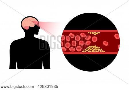 Ischemic Brain Stroke, Arteriosclerosis In Human Head Silhouette. Cholesterol In Blood Vessels. Fat 